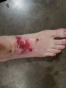 wound care